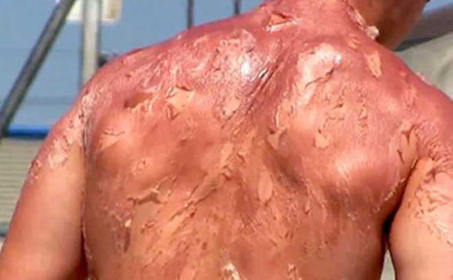 Cháy nắng - Hình ảnh minh họa